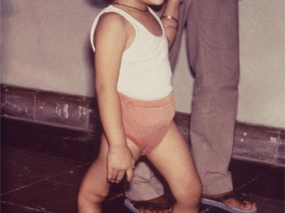 UNVACCINATED CHILD INFECTED WITH POLIO&nbsp;JERUSALEM